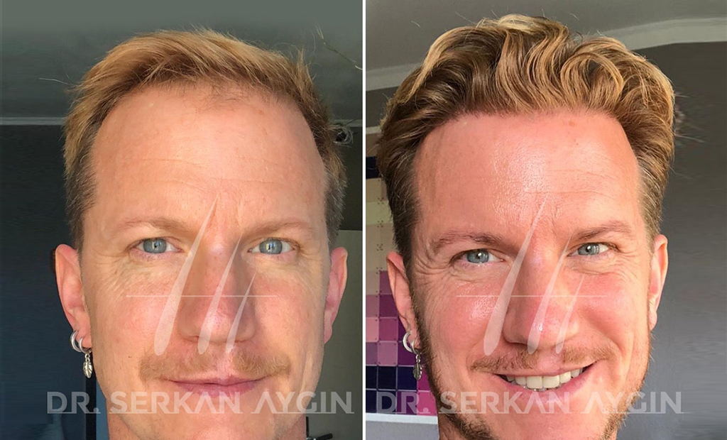 Hair transplant before and after: What to expect