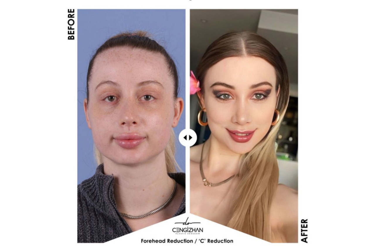 Best forehead reduction surgery in Turkey: How hairline lowering can transform facial proportions
