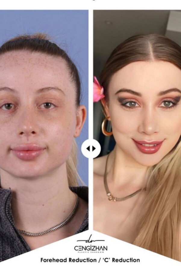 Best forehead reduction surgery in Turkey: How hairline lowering can transform facial proportions